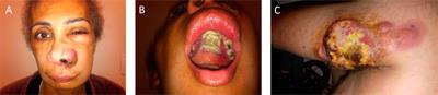 Extranodal NK-/T-cell lymphoma, nasal type: what advances have been made in the last decade?